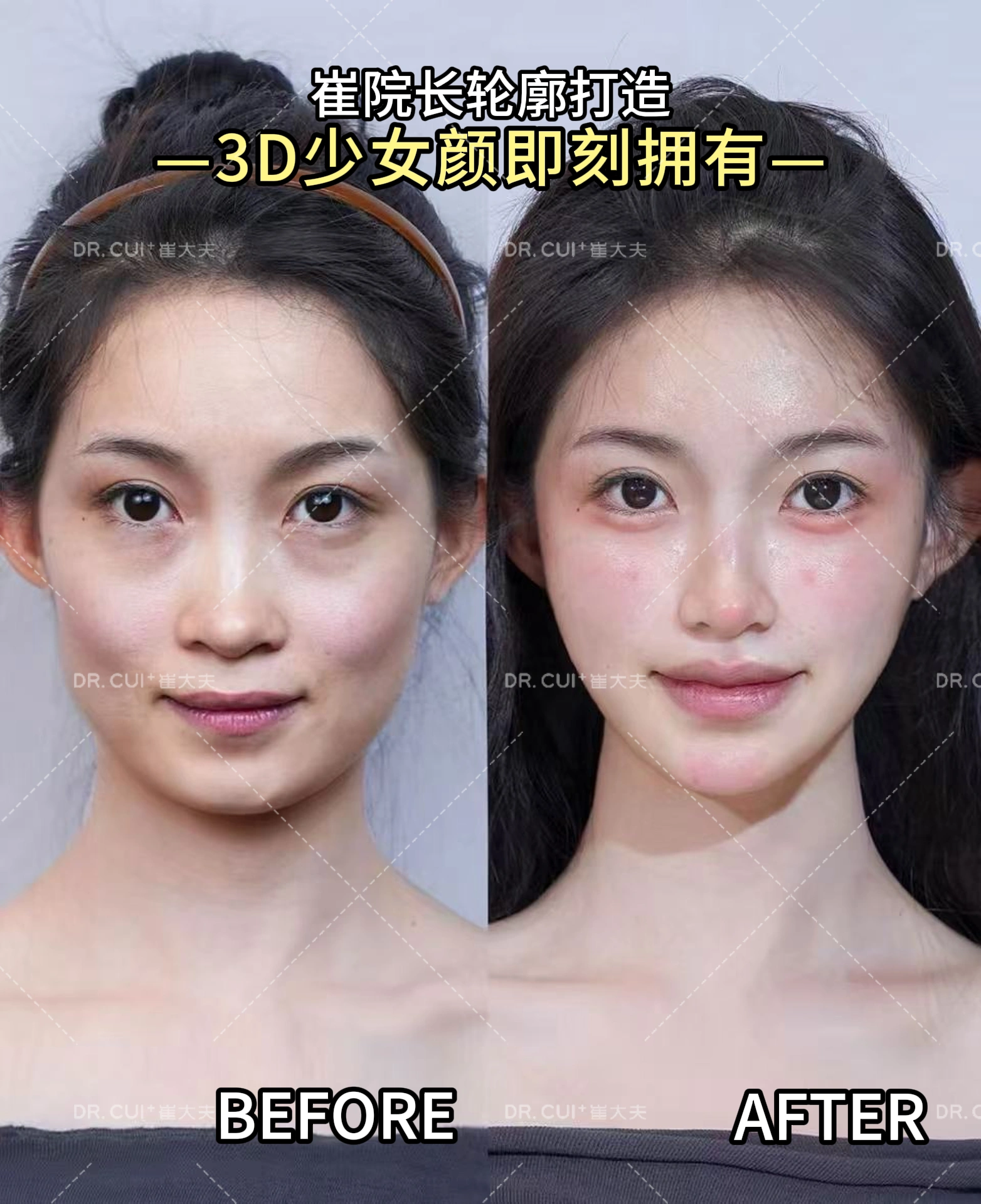 卧蚕案例4