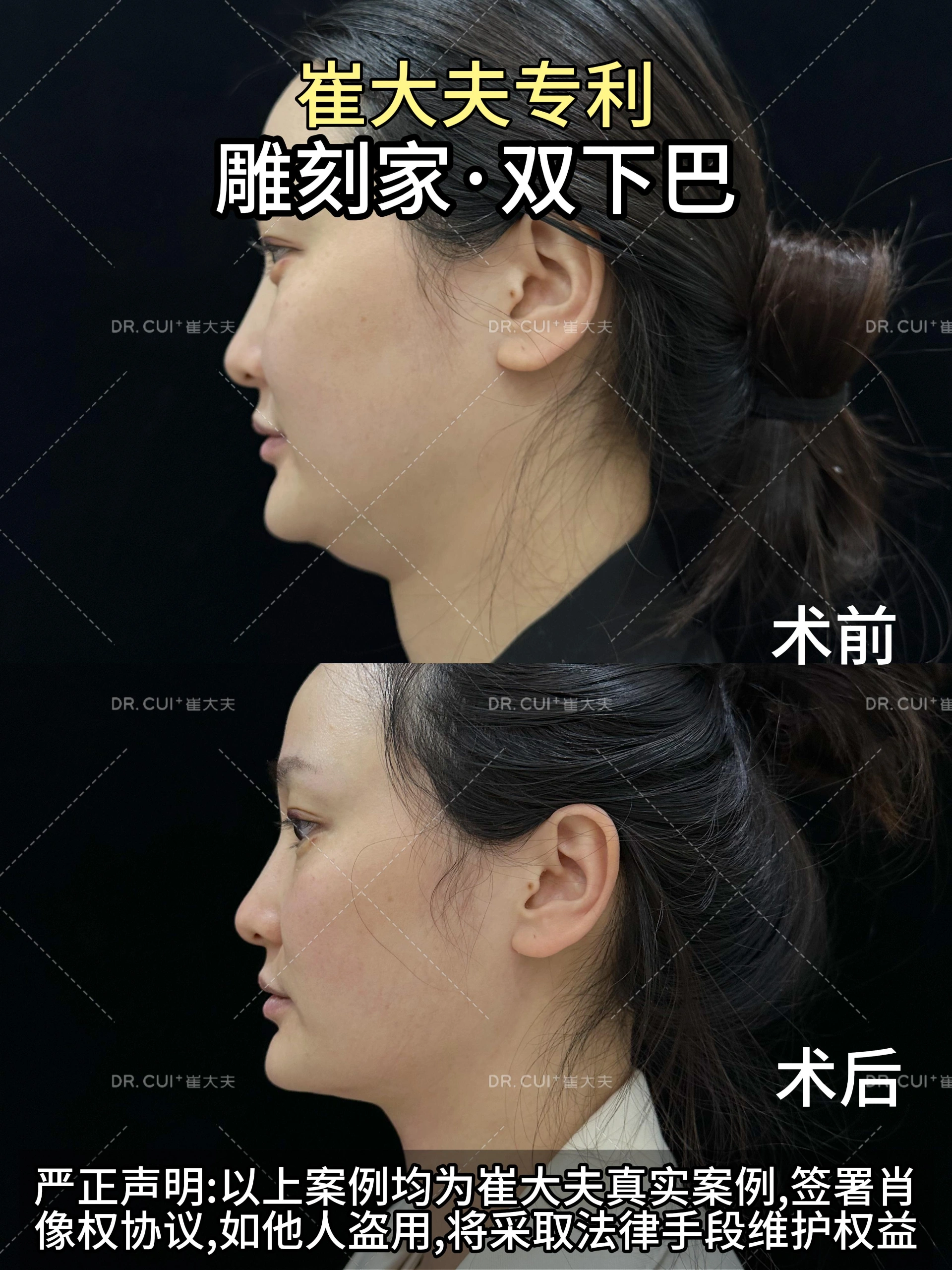 12月9日张艳龙雕刻家双下巴90°图