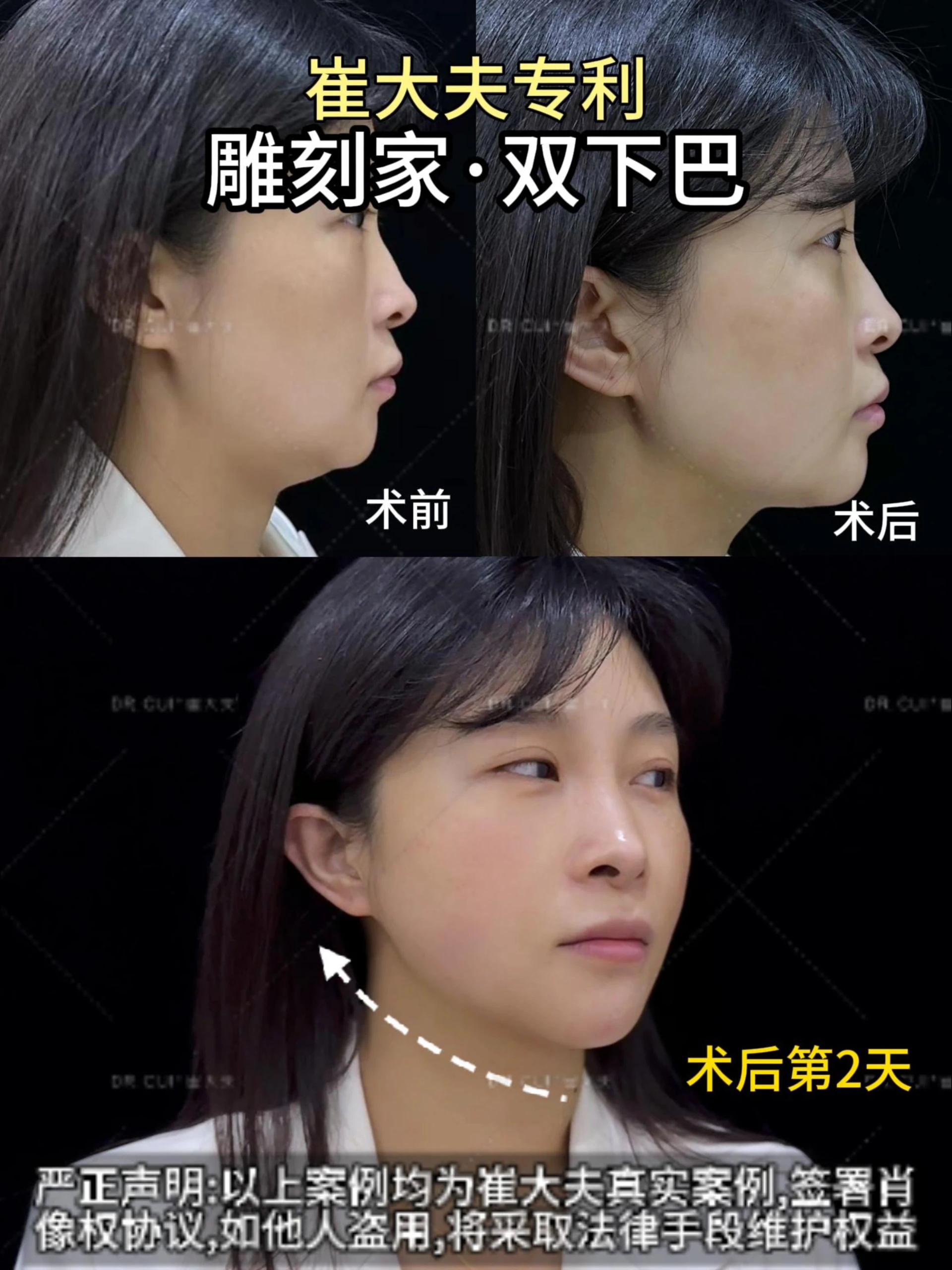 樊庆花雕刻家双下巴封面图12月13日