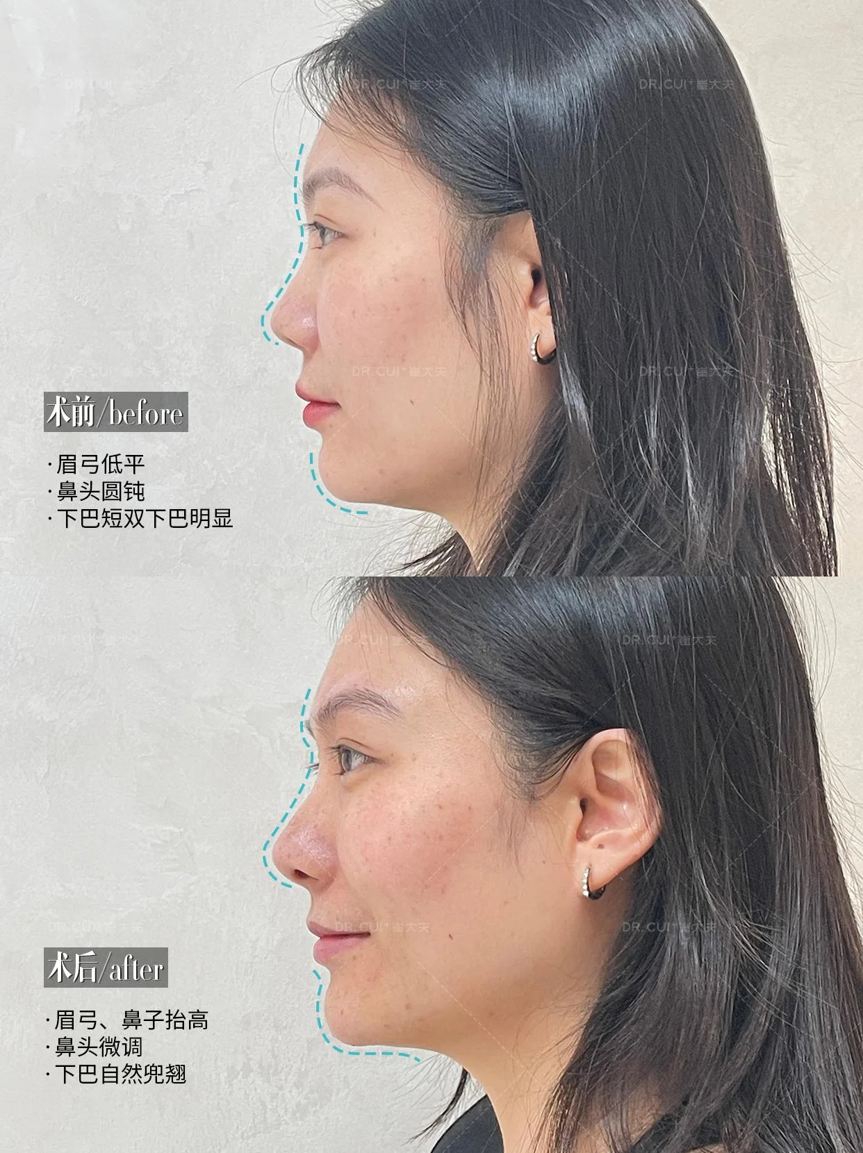 刘慧慧 对比(1)注射