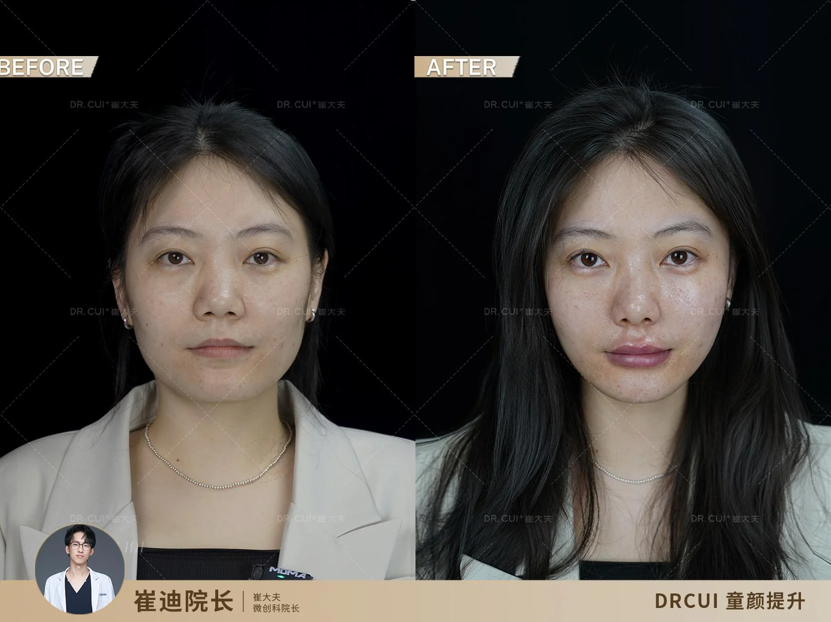 刘慧慧注射案例(1)注射