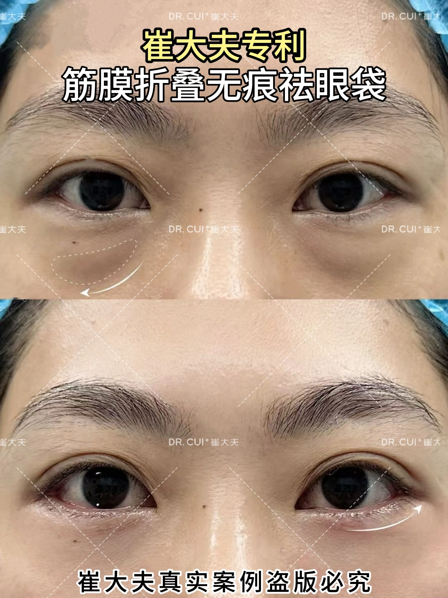 兰州崔大夫眼袋10