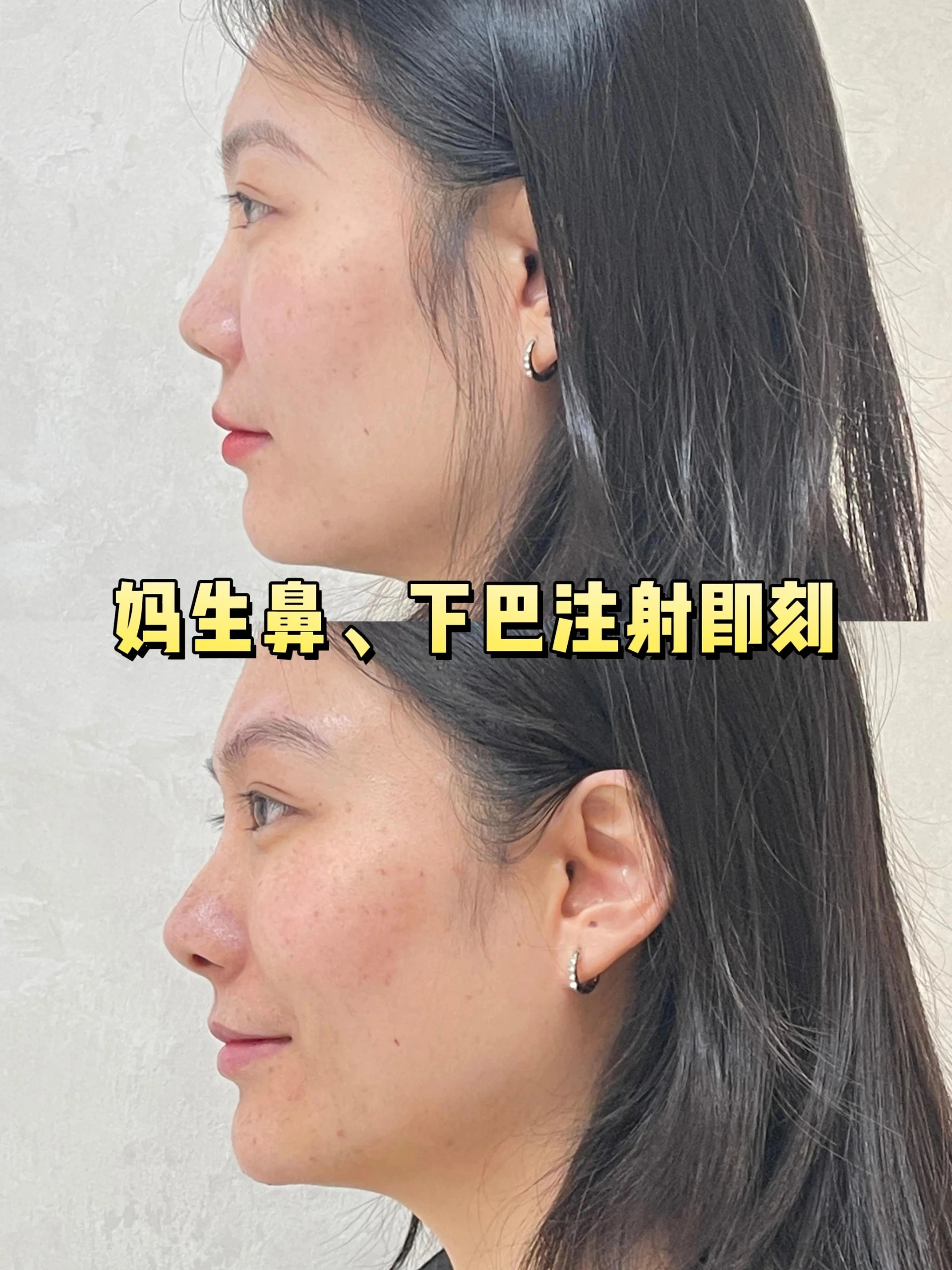 兰州崔大夫注射隆鼻8