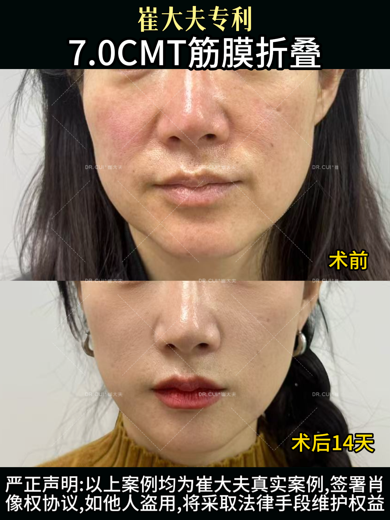 兰州崔大夫筋膜提升7