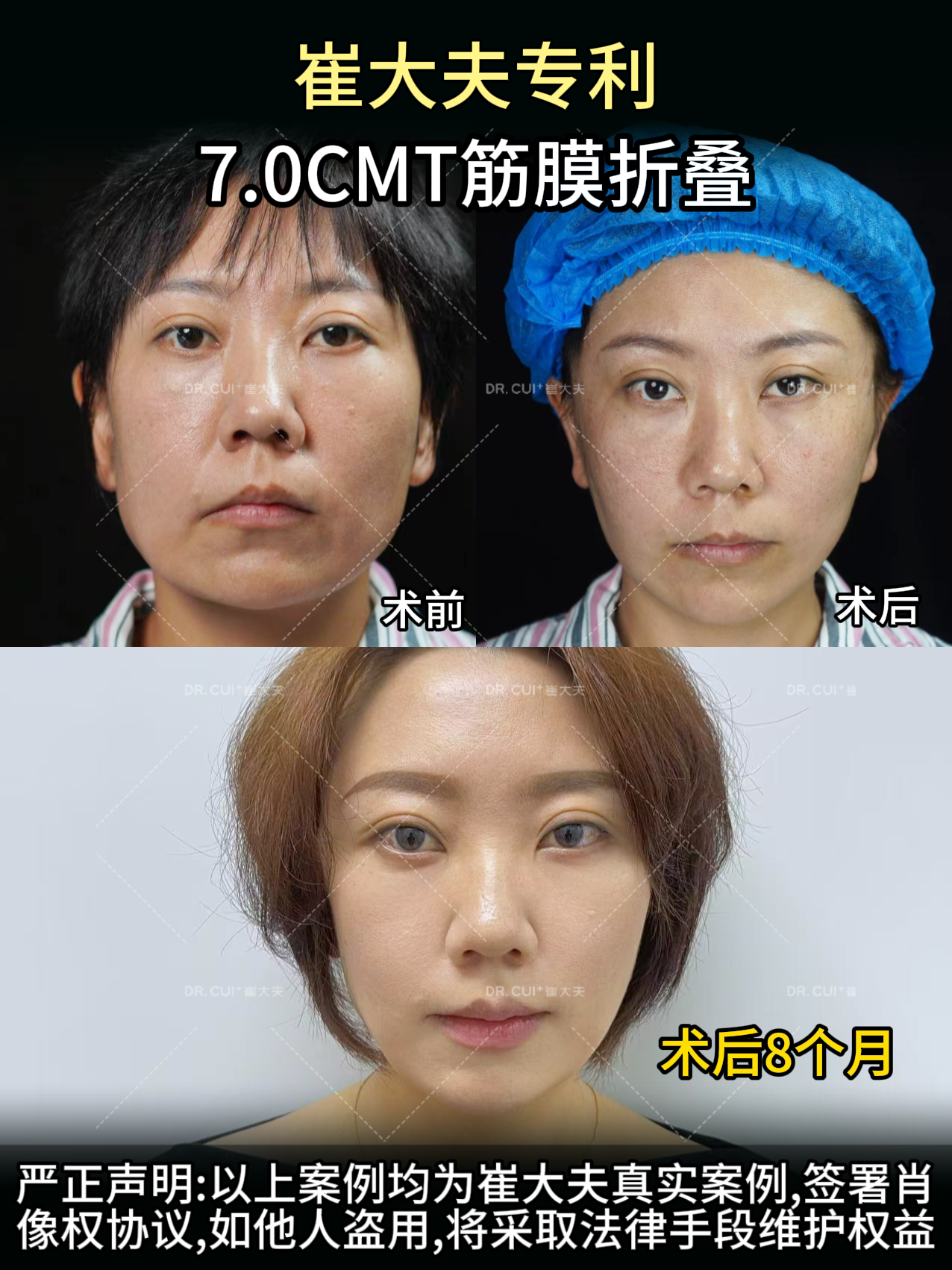 兰州崔大夫筋膜提升8