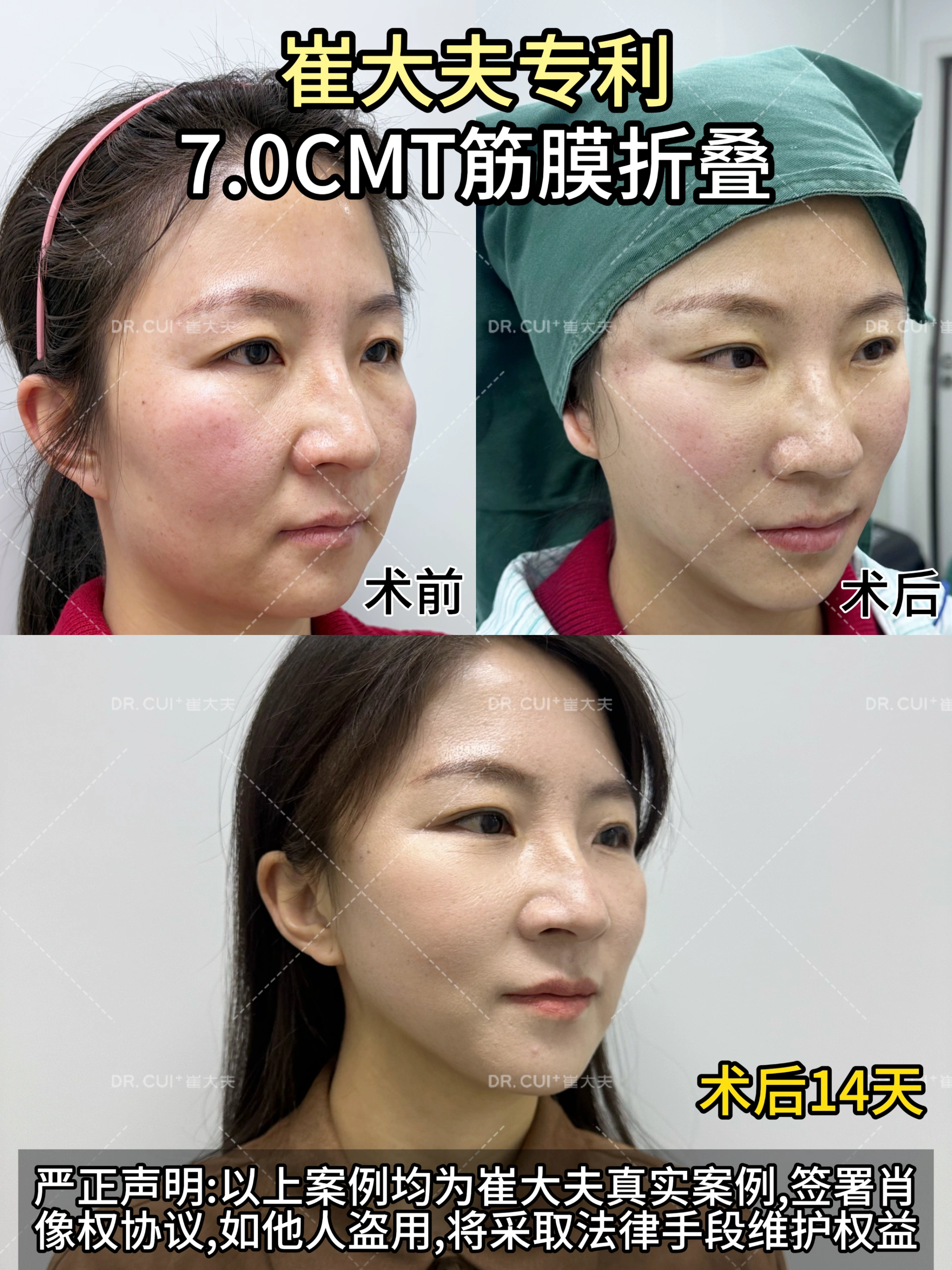 兰州崔大夫筋膜提升9